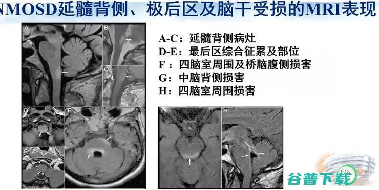 首都医科大学宣武医院副院长卢洁教授：AI在脑脱髓鞘病MRI中，有哪些应用？｜CMAI 2022