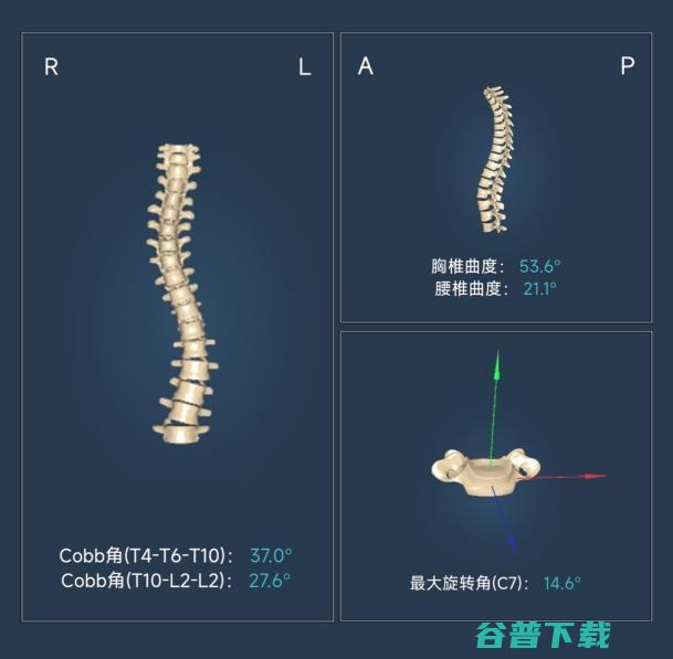 芙索特完成数千万Pre-A轮融资，助力全球儿童青少年脊柱健康筛查与诊疗